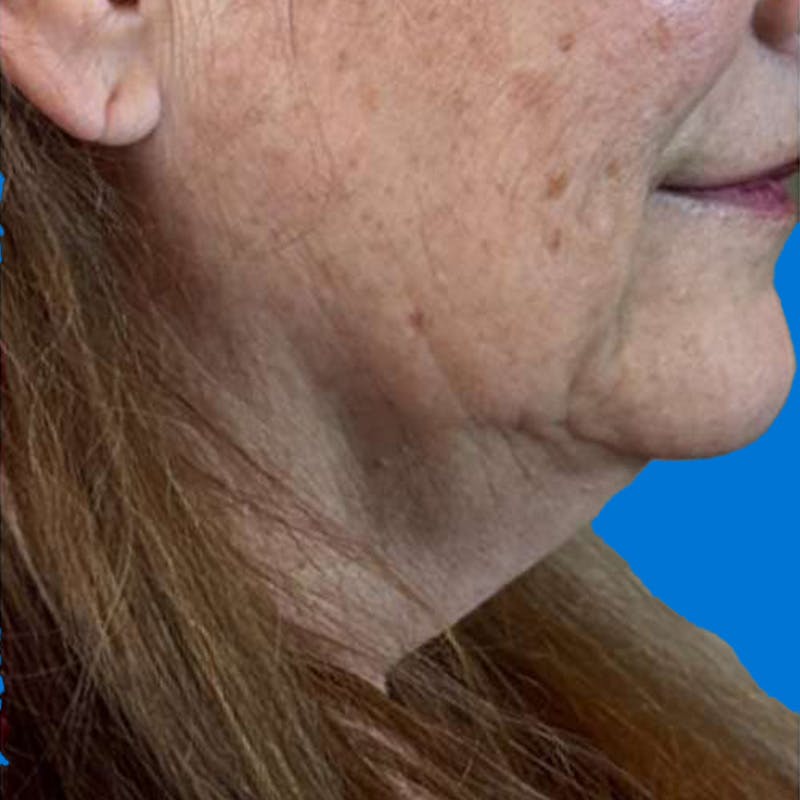 Junera Before & After Gallery - Patient 377975 - Image 1