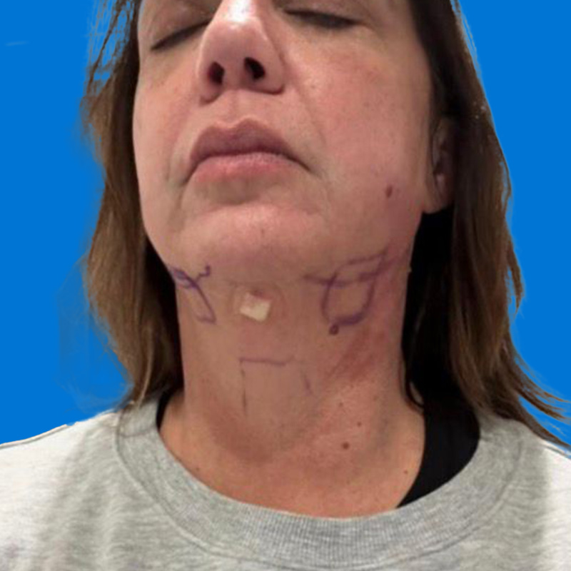 Junera Before & After Gallery - Patient 243482 - Image 4