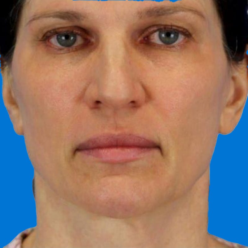 Junera Before & After Gallery - Patient 394078 - Image 1