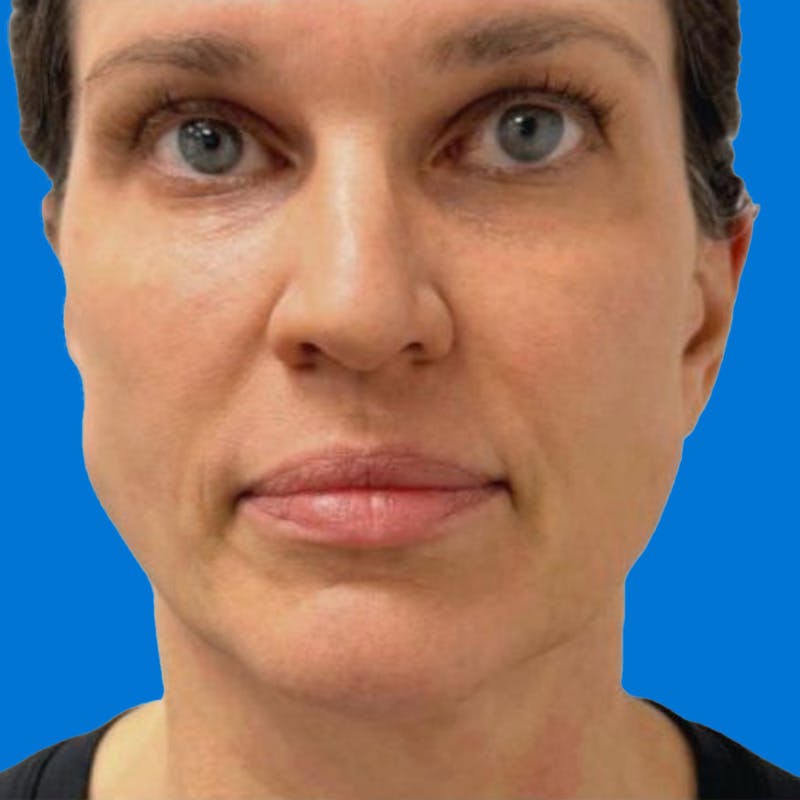 Junera Before & After Gallery - Patient 394078 - Image 2