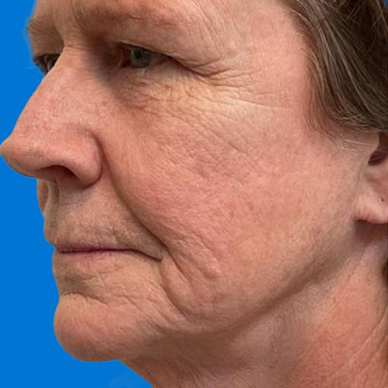 Junera Before & After Gallery - Patient 966508 - Image 1