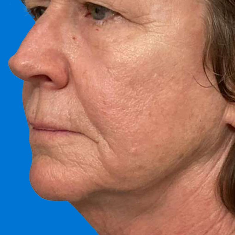 Junera Before & After Gallery - Patient 966508 - Image 2