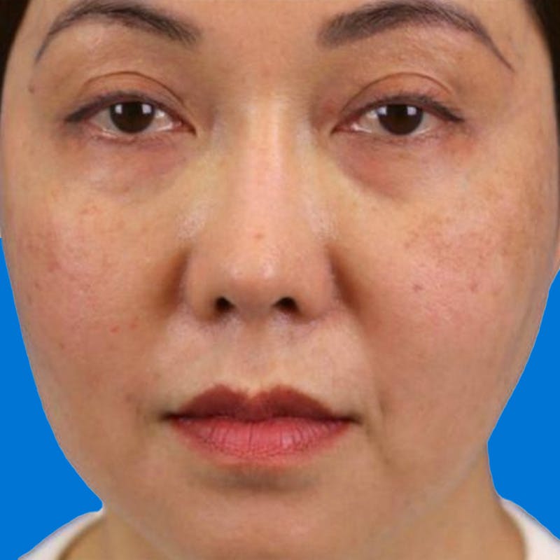 Junera Before & After Gallery - Patient 150696 - Image 1