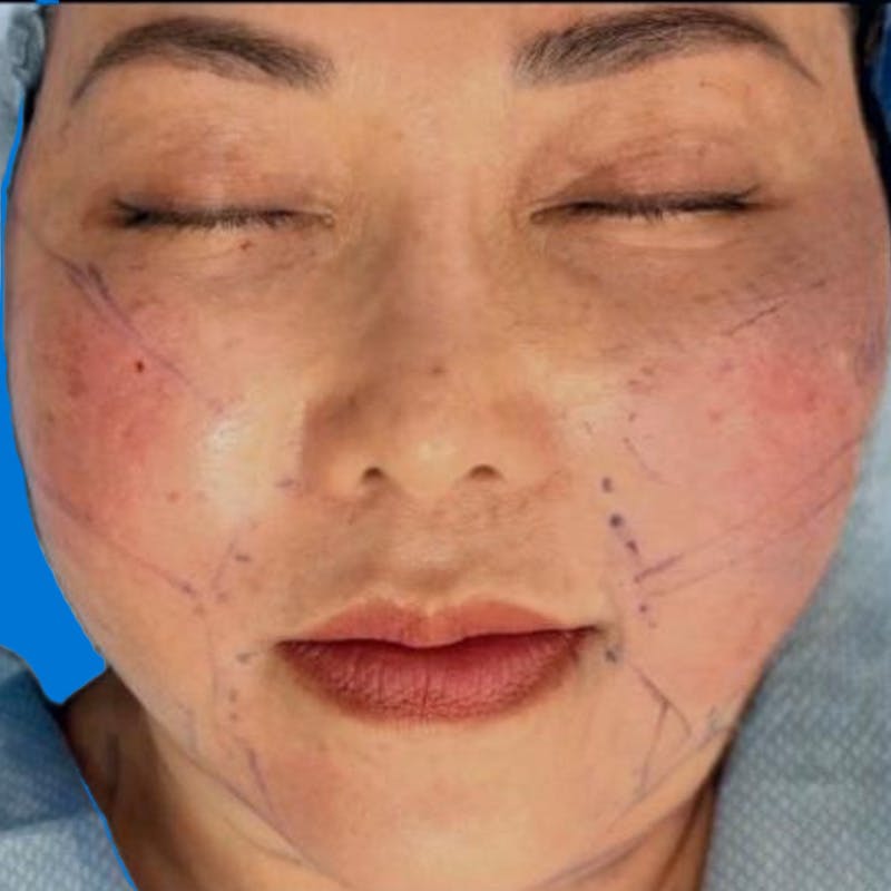 Junera Before & After Gallery - Patient 150696 - Image 2