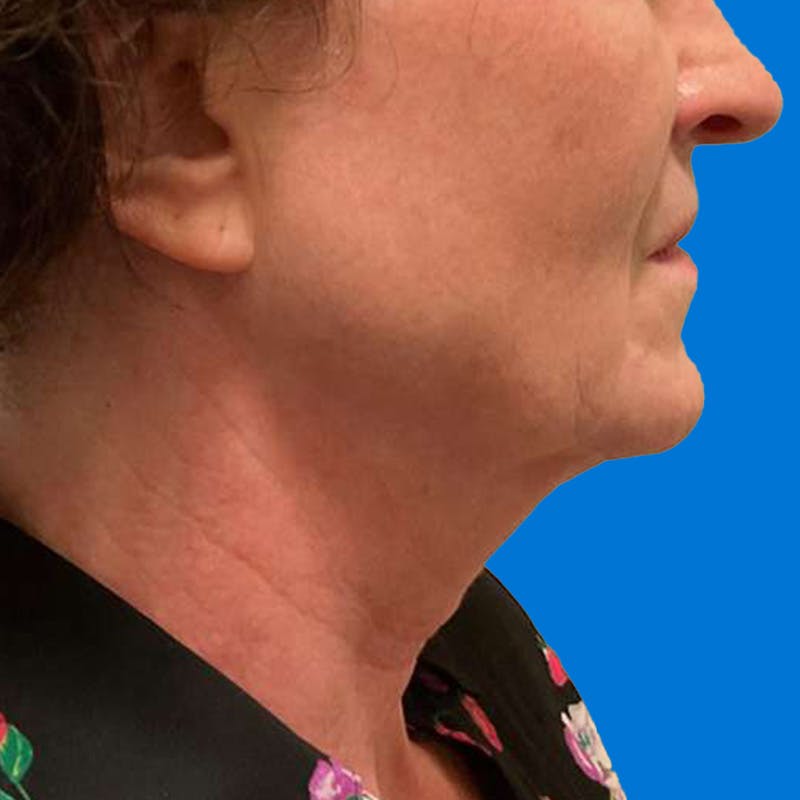 Junera Before & After Gallery - Patient 346872 - Image 1