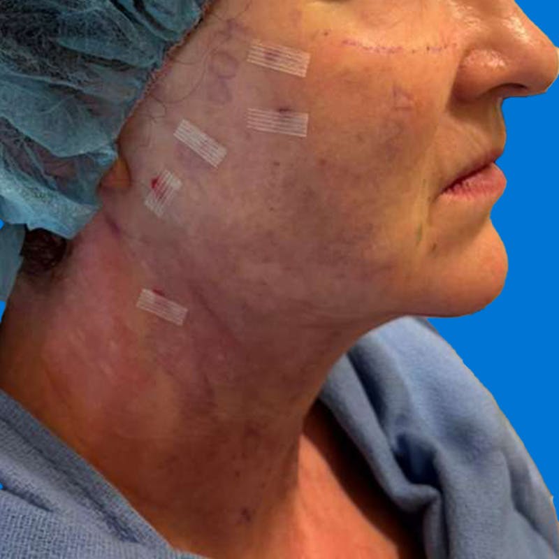 Junera Before & After Gallery - Patient 346872 - Image 2