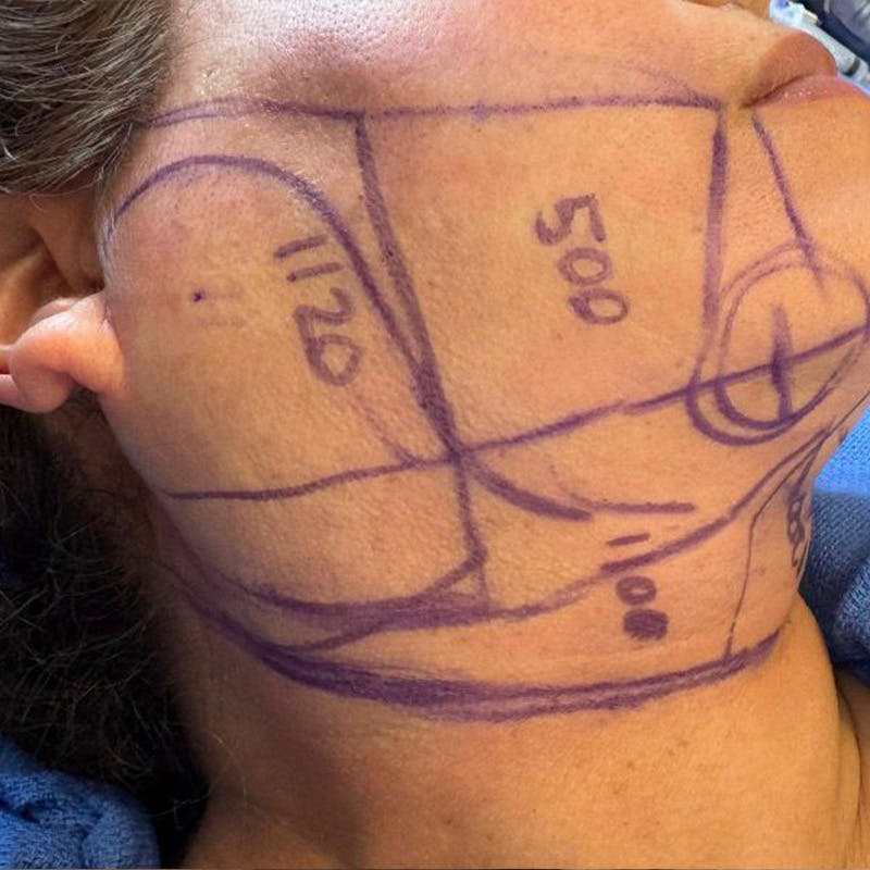 Junera Before & After Gallery - Patient 973149 - Image 1