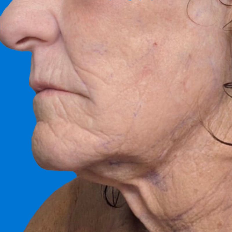 Junera Before & After Gallery - Patient 171005 - Image 2