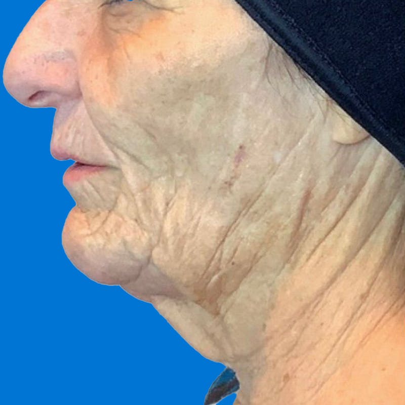 Junera Before & After Gallery - Patient 171005 - Image 1
