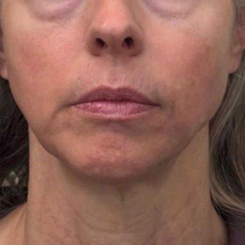 Junera Before & After Gallery - Patient 287069 - Image 1