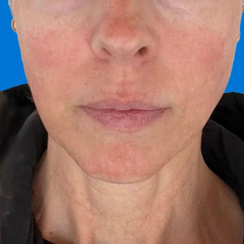 Junera Before & After Gallery - Patient 287069 - Image 2