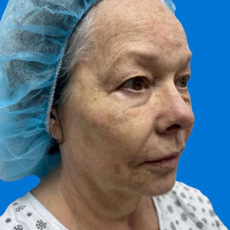 Junera Before & After Gallery - Patient 946740 - Image 1