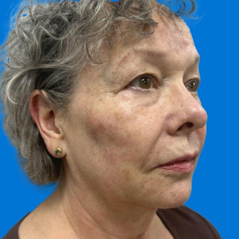 Junera Before & After Gallery - Patient 946740 - Image 2