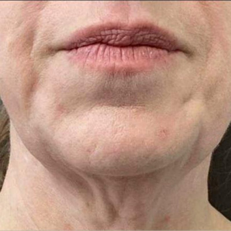 Junera Before & After Gallery - Patient 301149 - Image 1