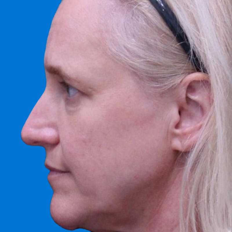Junera Before & After Gallery - Patient 152948 - Image 1