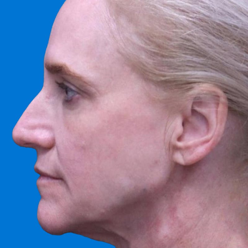 Junera Before & After Gallery - Patient 152948 - Image 2