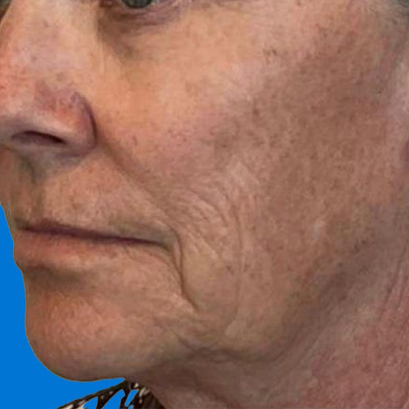 Junera Before & After Gallery - Patient 337262 - Image 1