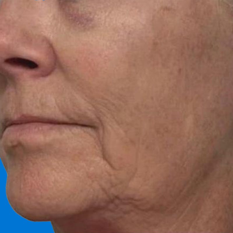 Junera Before & After Gallery - Patient 337262 - Image 2