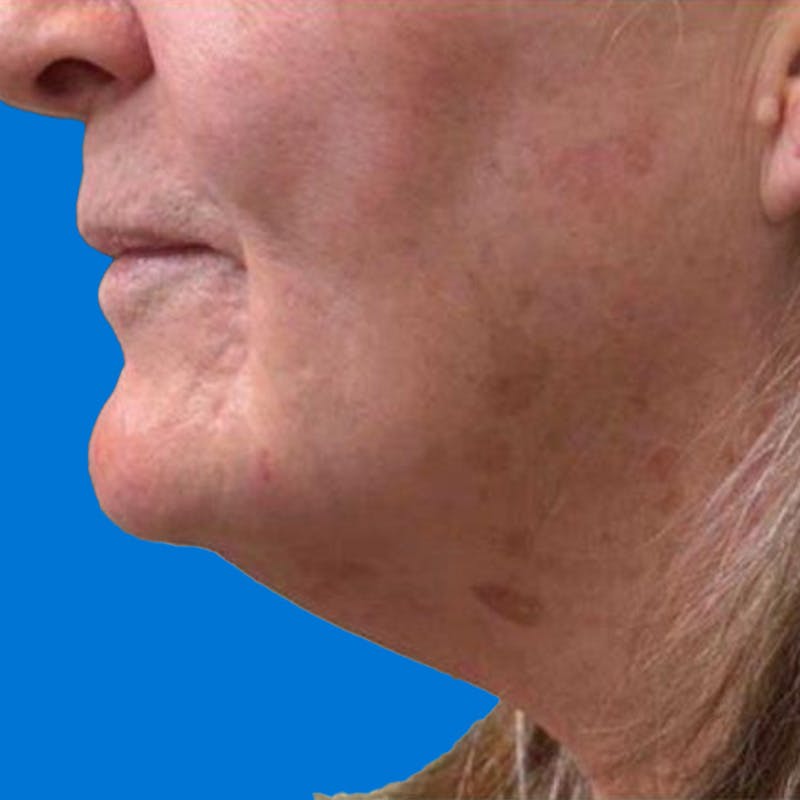 Junera Before & After Gallery - Patient 260998 - Image 1