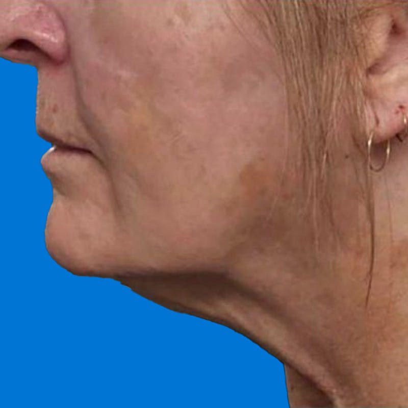 Junera Before & After Gallery - Patient 260998 - Image 2