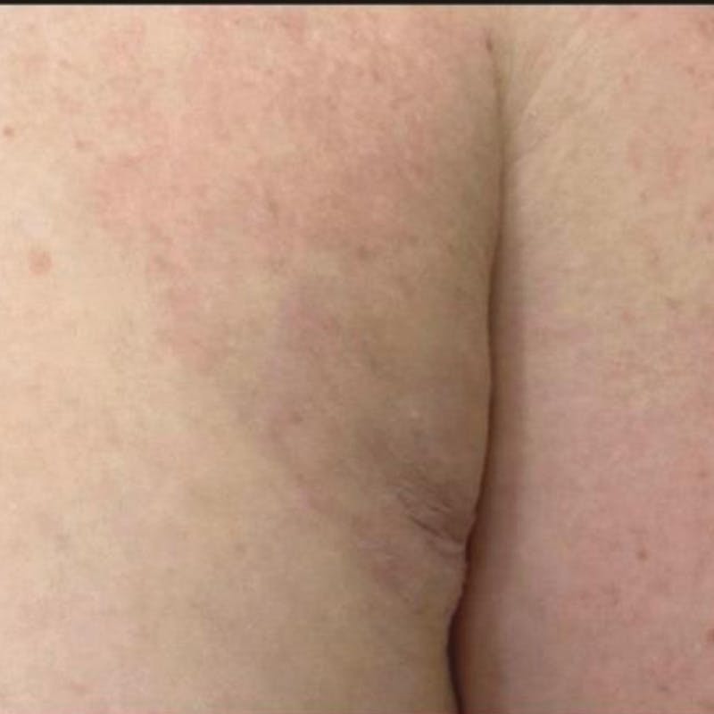 Junera Before & After Gallery - Patient 333988 - Image 2