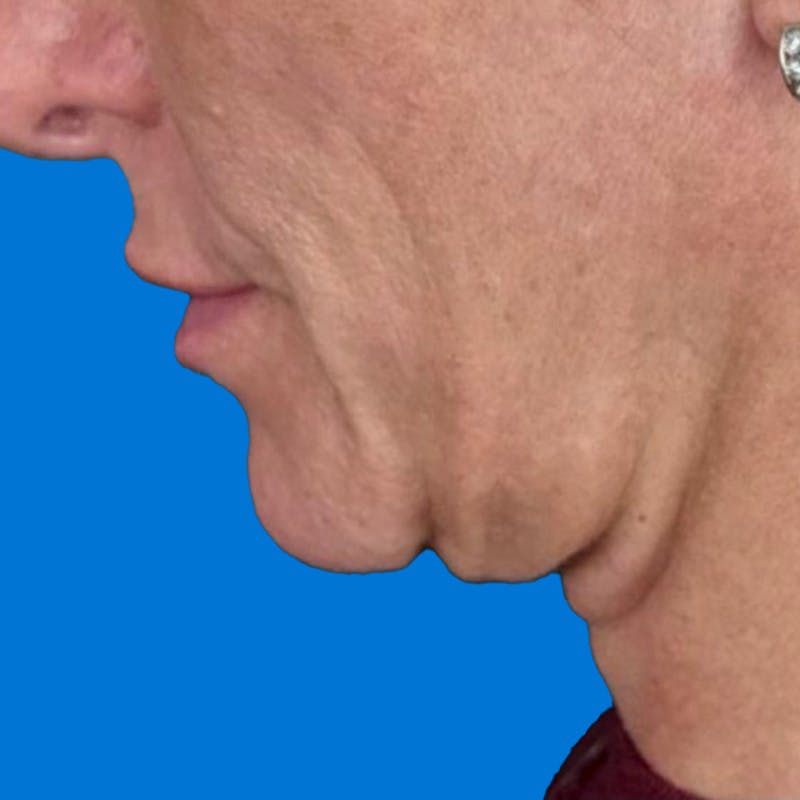 Junera Before & After Gallery - Patient 173203 - Image 1