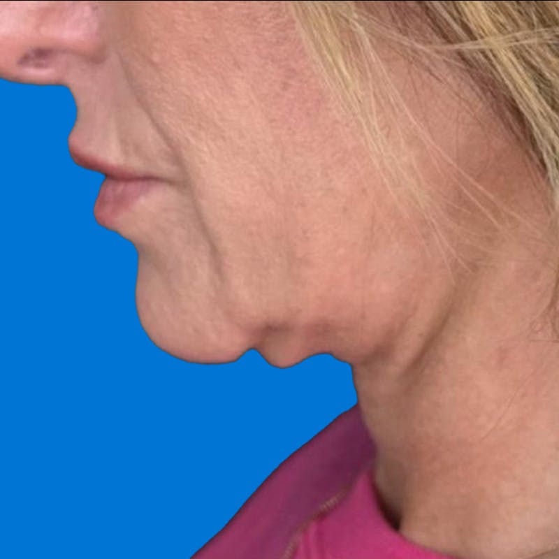 Junera Before & After Gallery - Patient 173203 - Image 2