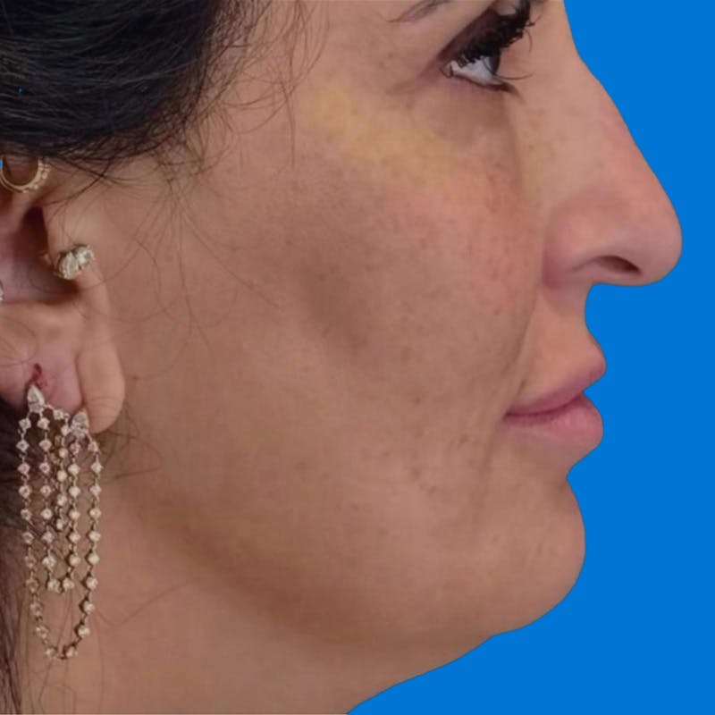 Junera Before & After Gallery - Patient 143947 - Image 1