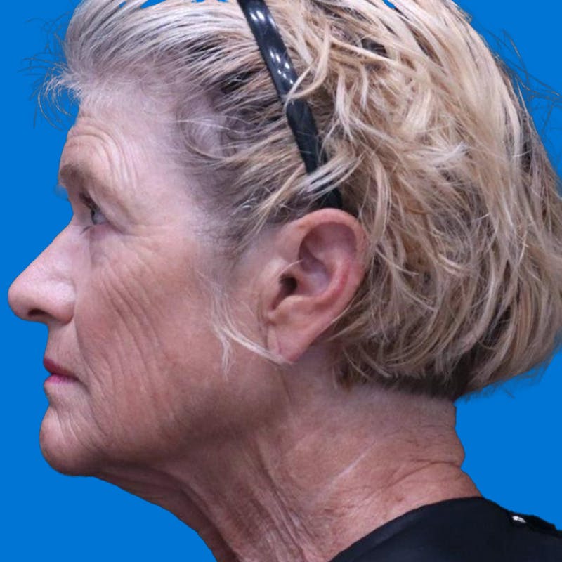 Junera Before & After Gallery - Patient 359602 - Image 1