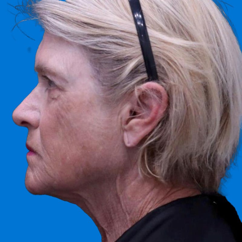 Junera Before & After Gallery - Patient 359602 - Image 2
