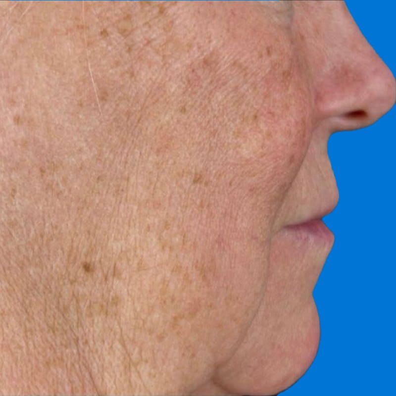 Junera Before & After Gallery - Patient 194178 - Image 1