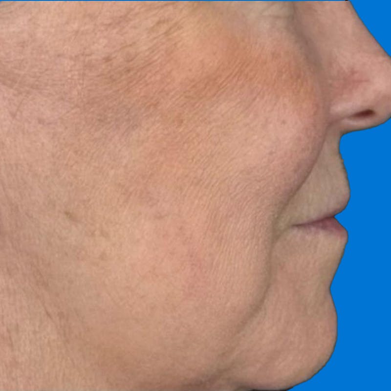 Junera Before & After Gallery - Patient 194178 - Image 2