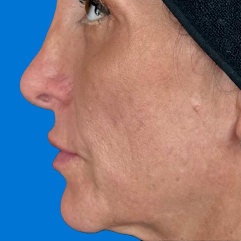 Junera Before & After Gallery - Patient 342701 - Image 1