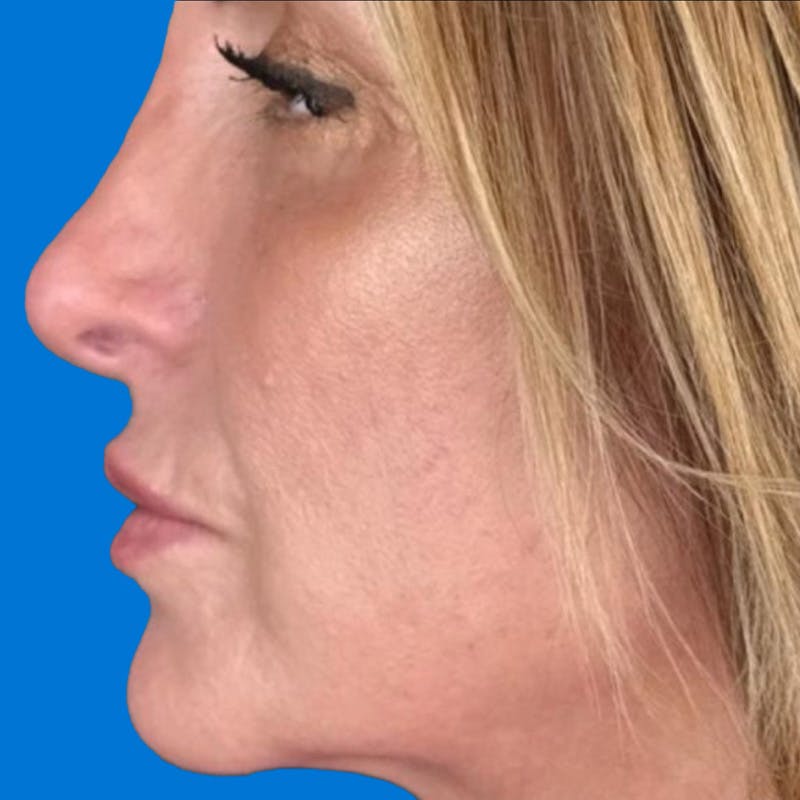 Junera Before & After Gallery - Patient 342701 - Image 2