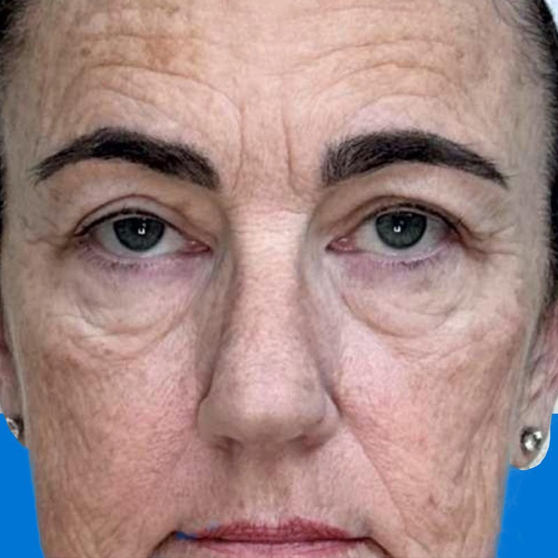 Junera Before & After Gallery - Patient 274858 - Image 1