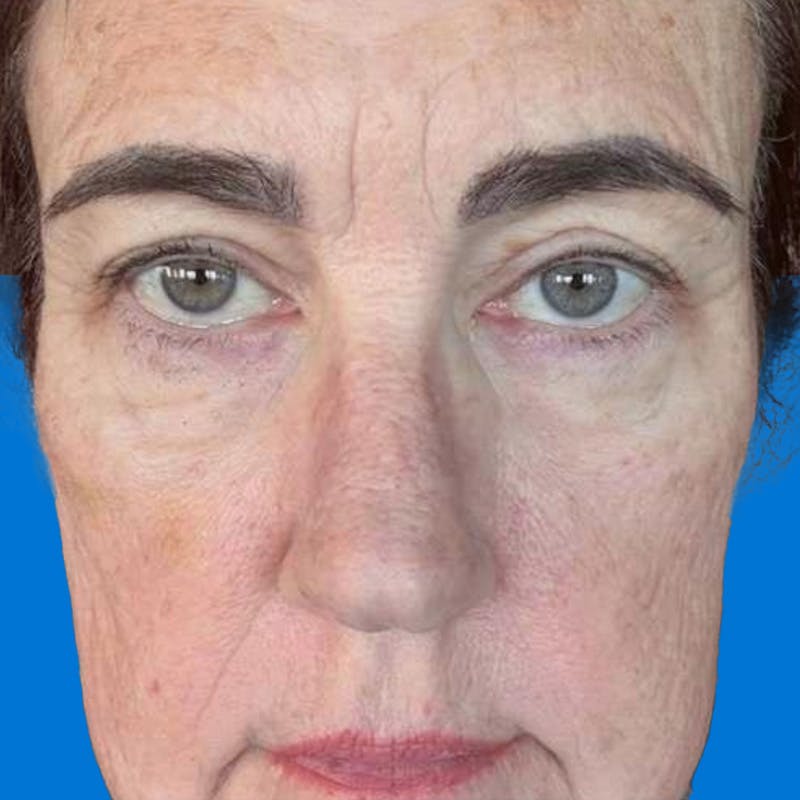 Junera Before & After Gallery - Patient 274858 - Image 2