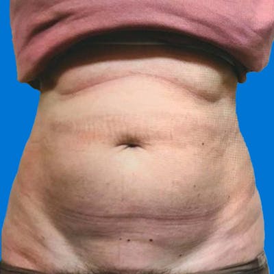 Junera Before & After Gallery - Patient 400543 - Image 1