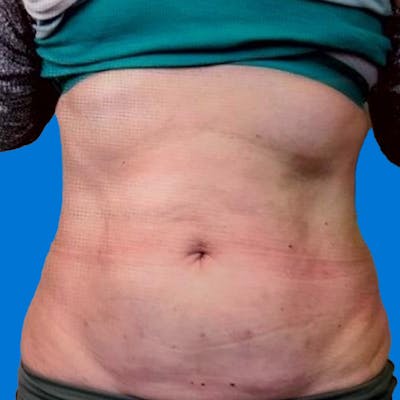 Junera Before & After Gallery - Patient 400543 - Image 2
