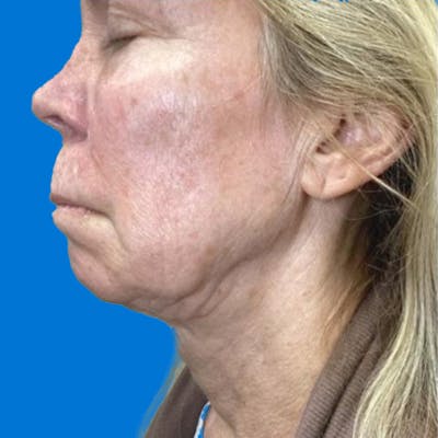 Junera Before & After Gallery - Patient 784003 - Image 1