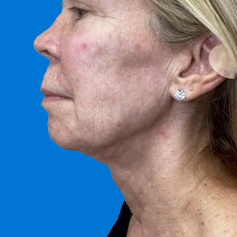 Junera Before & After Gallery - Patient 784003 - Image 2