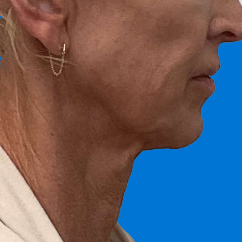 Junera Before & After Gallery - Patient 391669 - Image 1