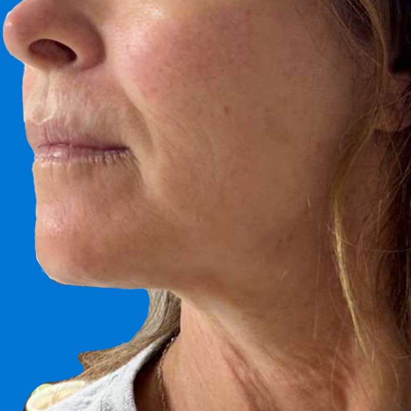 Junera Before & After Gallery - Patient 301002 - Image 2