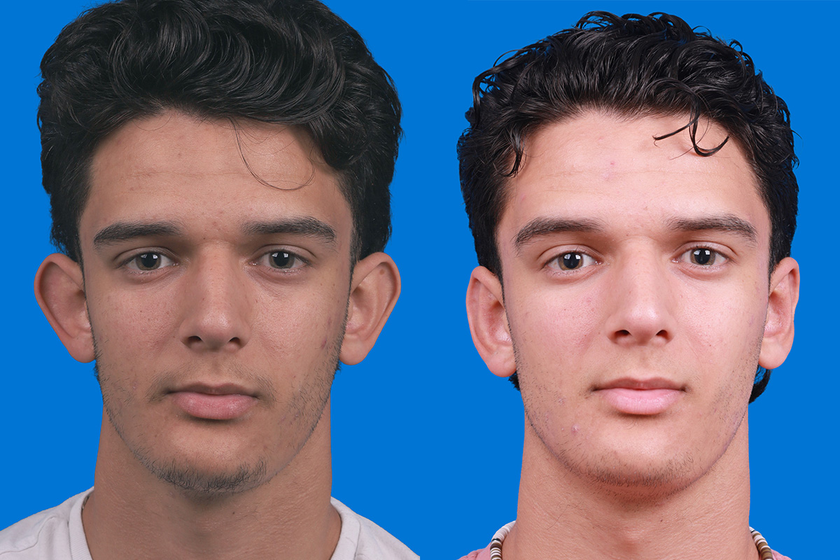 Ear Surgery Before & After Gallery - Patient 289291 - Image 1