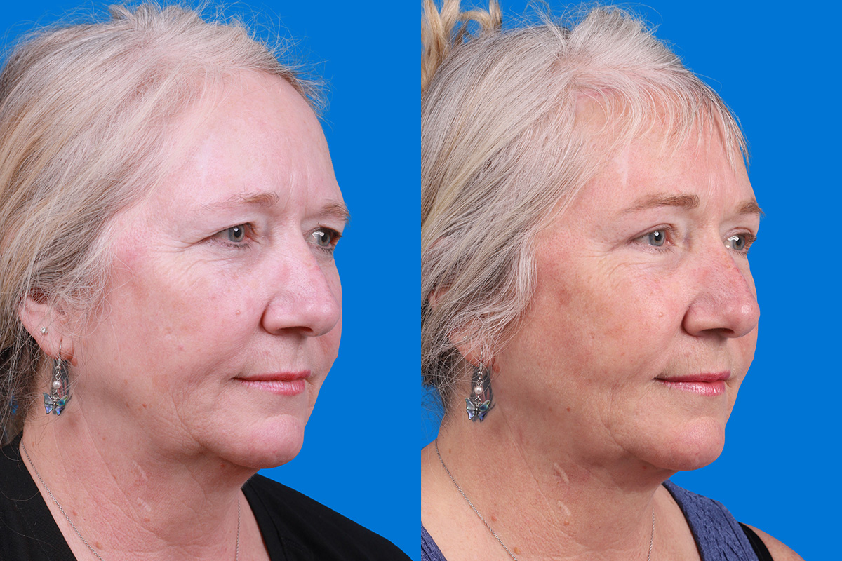 Brow Lift Before & After Gallery - Patient 103374 - Image 2
