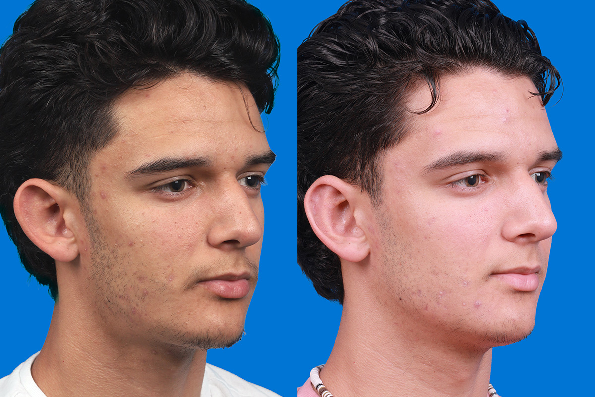 Ear Surgery Before & After Gallery - Patient 289291 - Image 2