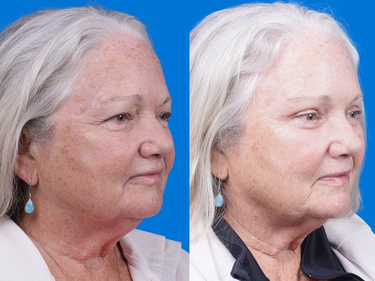 Brow Lift Before & After Gallery - Patient 417190 - Image 2