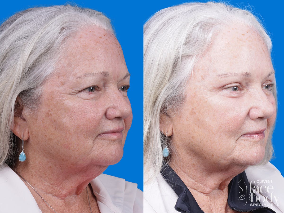 Eyelid Surgery Before & After Gallery - Patient 357388 - Image 2
