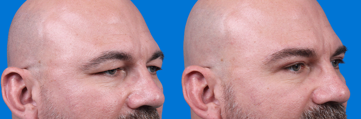 Brow Lift Before & After Gallery - Patient 202449 - Image 2