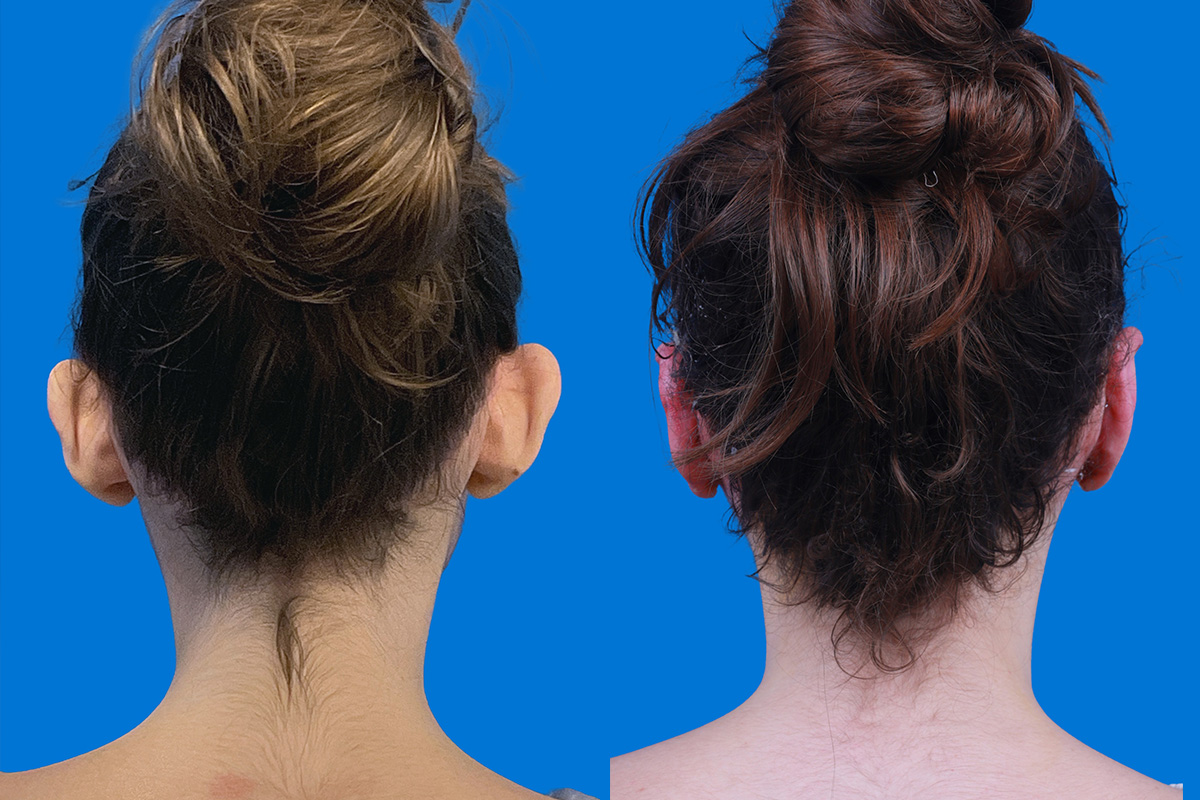 Ear Surgery Before & After Gallery - Patient 403787 - Image 1