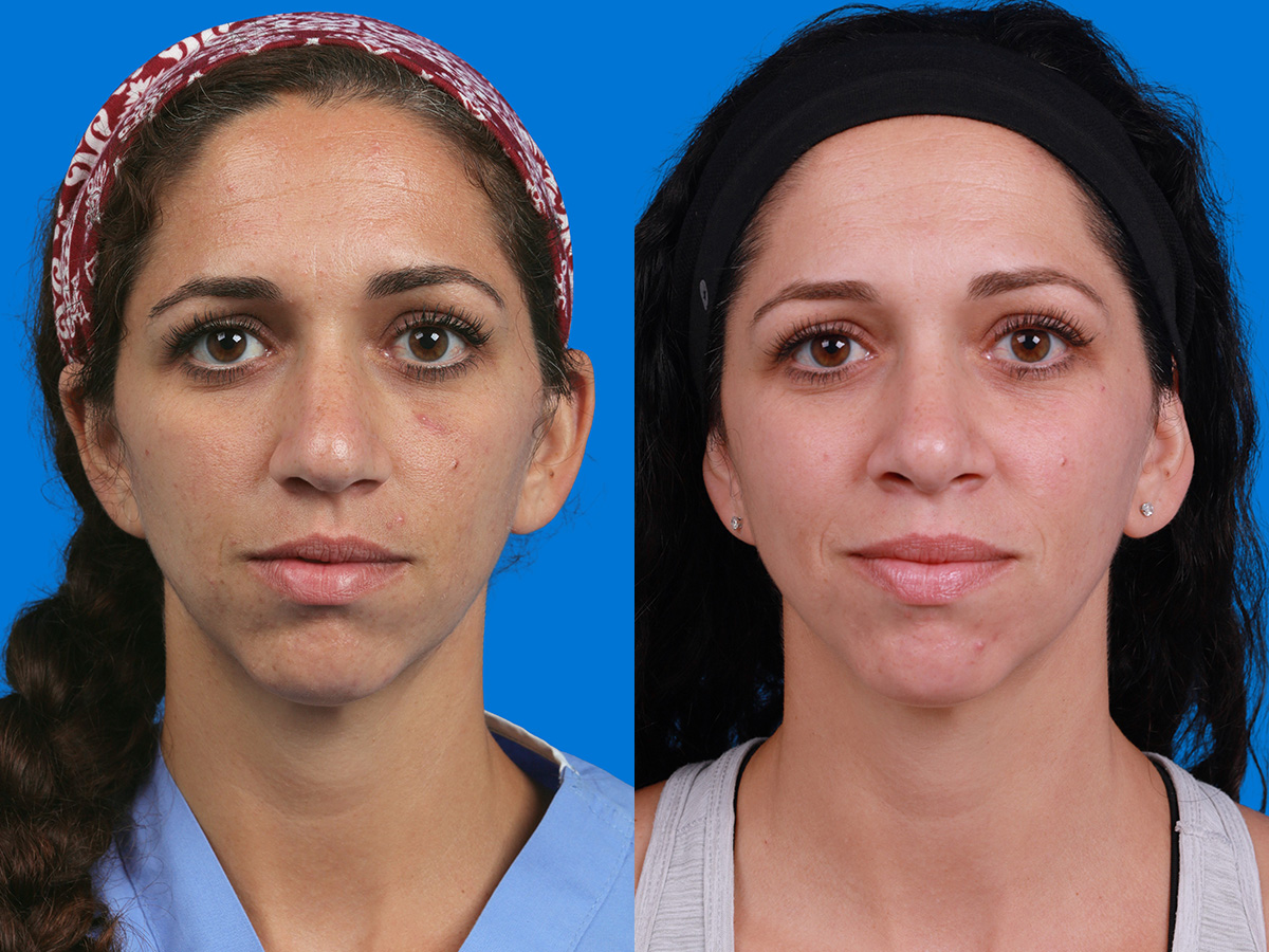 Rhinoplasty Before & After Gallery - Patient 173490 - Image 1